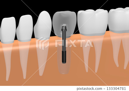 Tooth implant, other healthy teeth and gum - 3D illustration Tooth implant, other healthy teeth and gum - 3D illustration 133304781