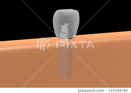 Tooth implant and gum - 3D illustration 133304785