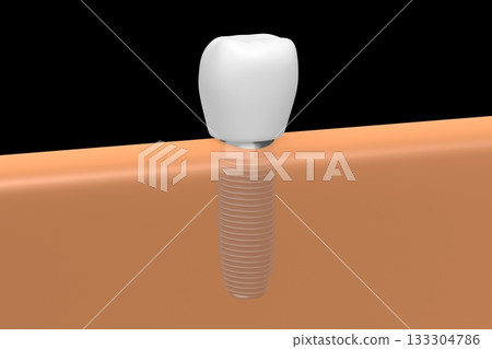 Tooth implant and gum - 3D illustration 133304786
