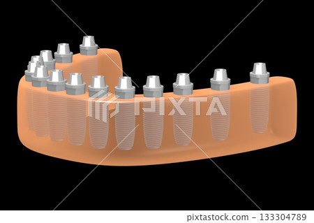 Dental teeth implats in gum - 3D illustration Dental teeth implats in gum - 3D illustration 133304789