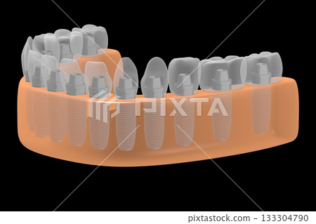 Dental teeth implats in gum - 3D illustration Dental teeth implats in gum - 3D illustration 133304790