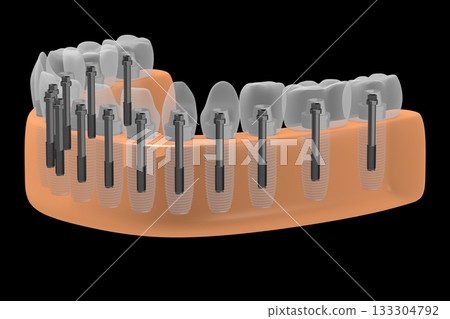 Dental teeth implats in gum - 3D illustration 133304792