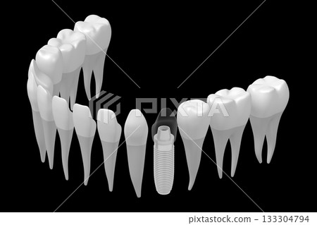 Health teeth and one implant isolated on white background - 3D illustration Health teeth and one implant isolated on white background - 3D illustration 133304794