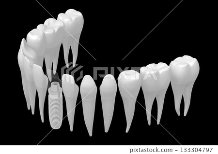 Health teeth and one implant isolated on white background - 3D illustration Health teeth and one implant isolated on white background - 3D illustration 133304797