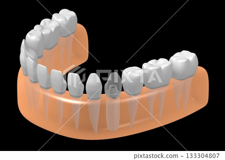 Tooth implant and healthy ones in gum - 3D illustration Tooth implant and healthy ones in gum - 3D illustration 133304807