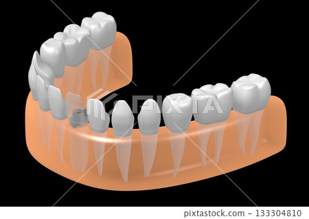 Tooth implant and healthy ones in gum - 3D illustration Tooth implant and healthy ones in gum - 3D illustration 133304810