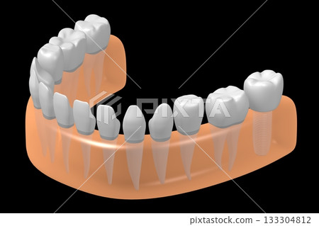 Tooth implant and healthy ones in gum - 3D illustration Tooth implant and healthy ones in gum - 3D illustration 133304812