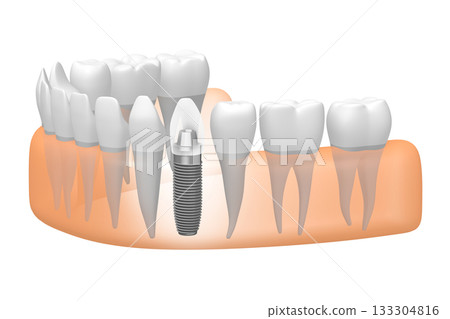 Tooth implant, other healthy teeth and gum - 3D illustration 133304816
