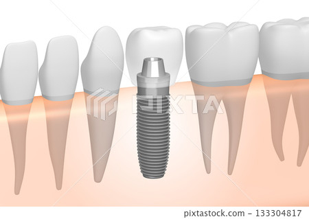 Tooth implant, other healthy teeth and gum - 3D illustration 133304817
