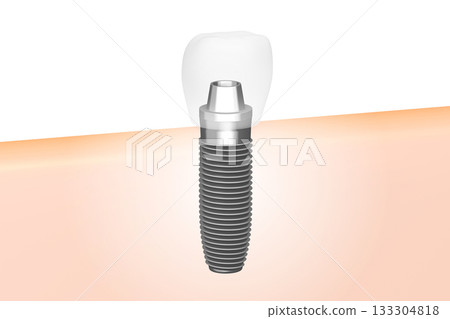 Tooth implant and gum - 3D illustration 133304818