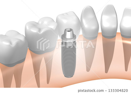 Tooth implant, other healthy teeth and gum - 3D illustration 133304820