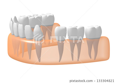 Gum with teeth and one missing - 3D illustration 133304821