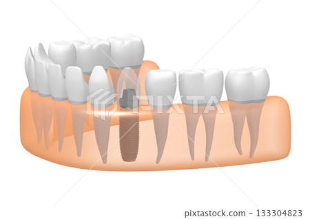 Tooth implant, other healthy teeth and gum - 3D illustration Tooth implant, other healthy teeth and gum - 3D illustration 133304823