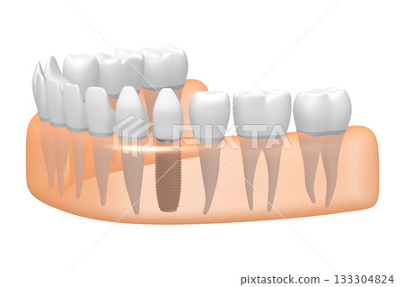 Tooth implant, other healthy teeth and gum - 3D illustration 133304824