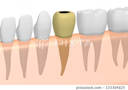 Decayed tooth and other ones in gum - 3D illustration Decayed tooth and other ones in gum - 3D illustration 133304825