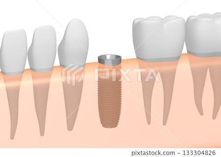 Tooth implant, other healthy teeth and gum - 3D illustration 133304826