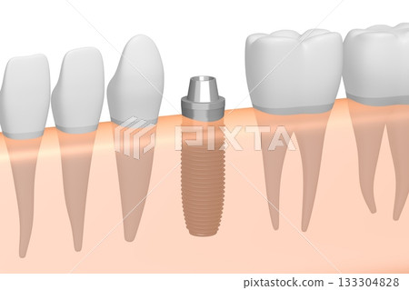 Tooth implant, other healthy teeth and gum - 3D illustration 133304828