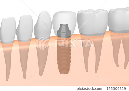 Tooth implant, other healthy teeth and gum - 3D illustration 133304829