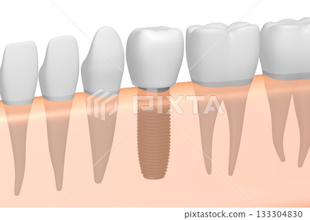 Tooth implant, other healthy teeth and gum - 3D illustration 133304830