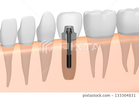 Tooth implant, other healthy teeth and gum - 3D illustration 133304831