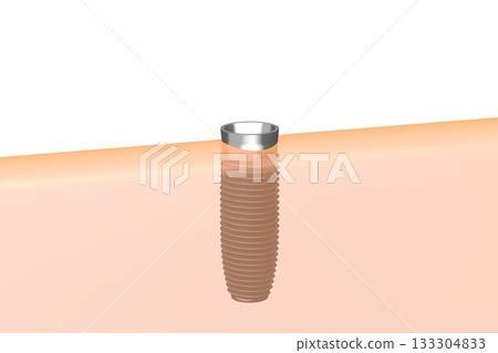 Tooth implant and gum - 3D illustration 133304833