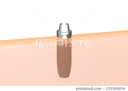 Tooth implant and gum - 3D illustration 133304834