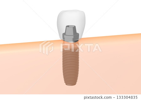 Tooth implant and gum - 3D illustration 133304835