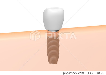 Tooth implant and gum - 3D illustration 133304836