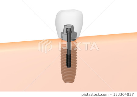 Tooth implant and gum - 3D illustration 133304837