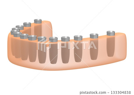 Dental teeth implats in gum - 3D illustration 133304838