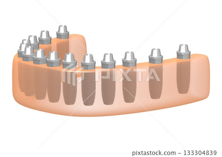Dental teeth implats in gum - 3D illustration 133304839