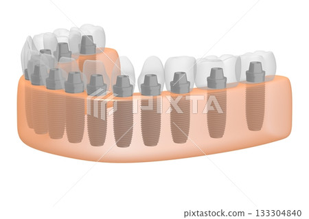 Dental teeth implats in gum - 3D illustration Dental teeth implats in gum - 3D illustration 133304840
