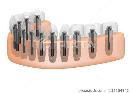 Dental teeth implats in gum - 3D illustration 133304842