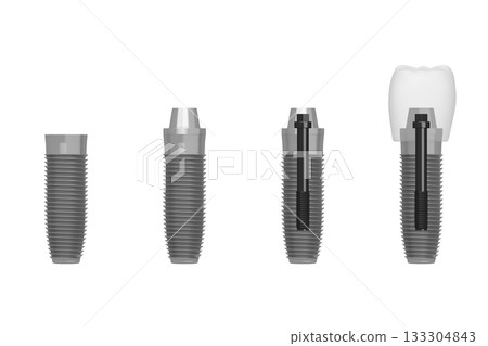 Steps of creating tooth implant - 3D illustration Steps of creating tooth implant - 3D illustration 133304843