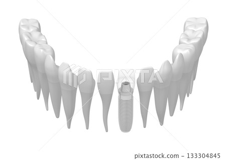 Health teeth and one implant isolated on white background - 3D illustration 133304845