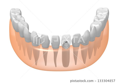 Tooth implant, other healthy ones and gum - 3D illustration Tooth implant, other healthy ones and gum - 3D illustration 133304857