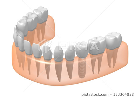 Tooth implant, other healthy ones and gum - 3D illustration 133304858