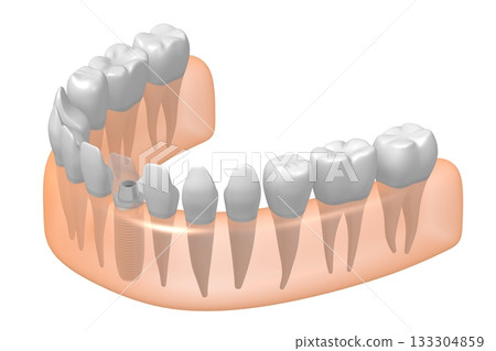 Tooth implant, other healthy ones and gum - 3D illustration 133304859