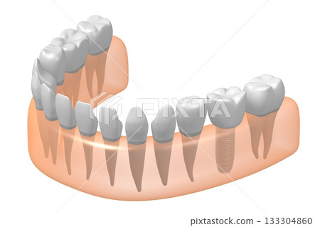 Tooth implant, other healthy ones and gum - 3D illustration Tooth implant, other healthy ones and gum - 3D illustration 133304860