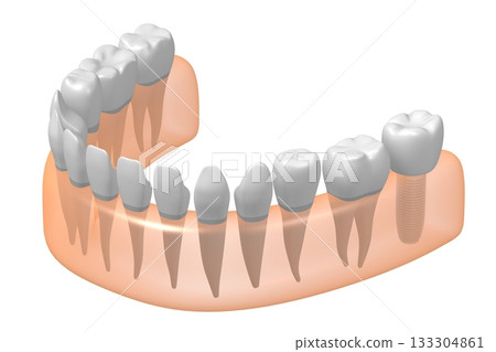 Tooth implant, other healthy ones and gum - 3D illustration Tooth implant, other healthy ones and gum - 3D illustration 133304861