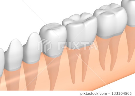 Tooth implant and healthy ones in gum - 3D illustration 133304865