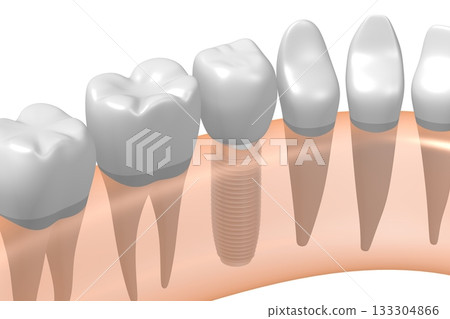 Tooth implant, other healthy ones and gum - 3D illustration 133304866