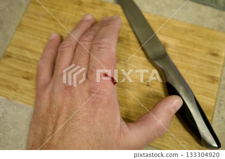 Kitchen knife accident minor cut Kitchen knife accident minor cut 133304920