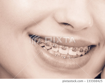 Woman showing her teeth with braces Woman showing her teeth with braces 133308425