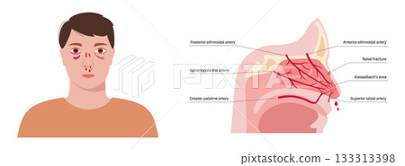 Nasal fracture poster Nasal fracture poster 133313398