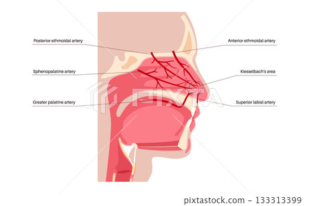 Nosebleed medical poster Nosebleed medical poster 133313399