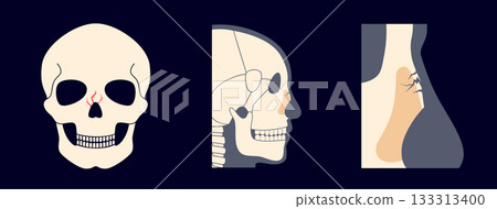 Nasal fracture poster 133313400