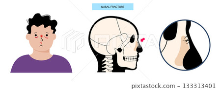 Nasal fracture poster Nasal fracture poster 133313401