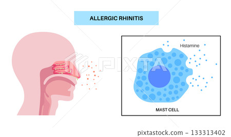 Allergic rhinitis poster Allergic rhinitis poster 133313402