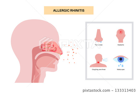 Allergic rhinitis poster 133313403